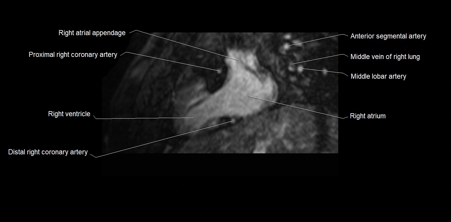 MRI heart and coronary arteries two chamber(sagittal)  anatomy image 8.webp
